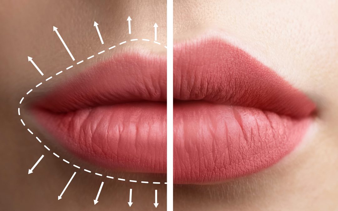 Revolax Lip Augmentation: A Comprehensive Guide