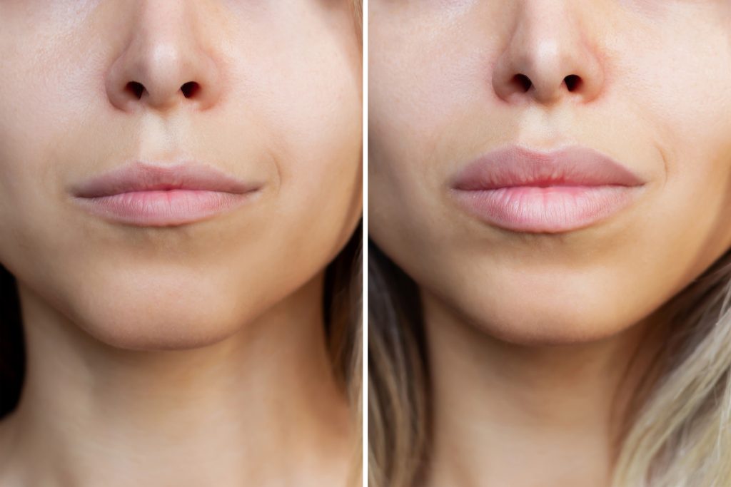 revolax lip filler vs juvederm