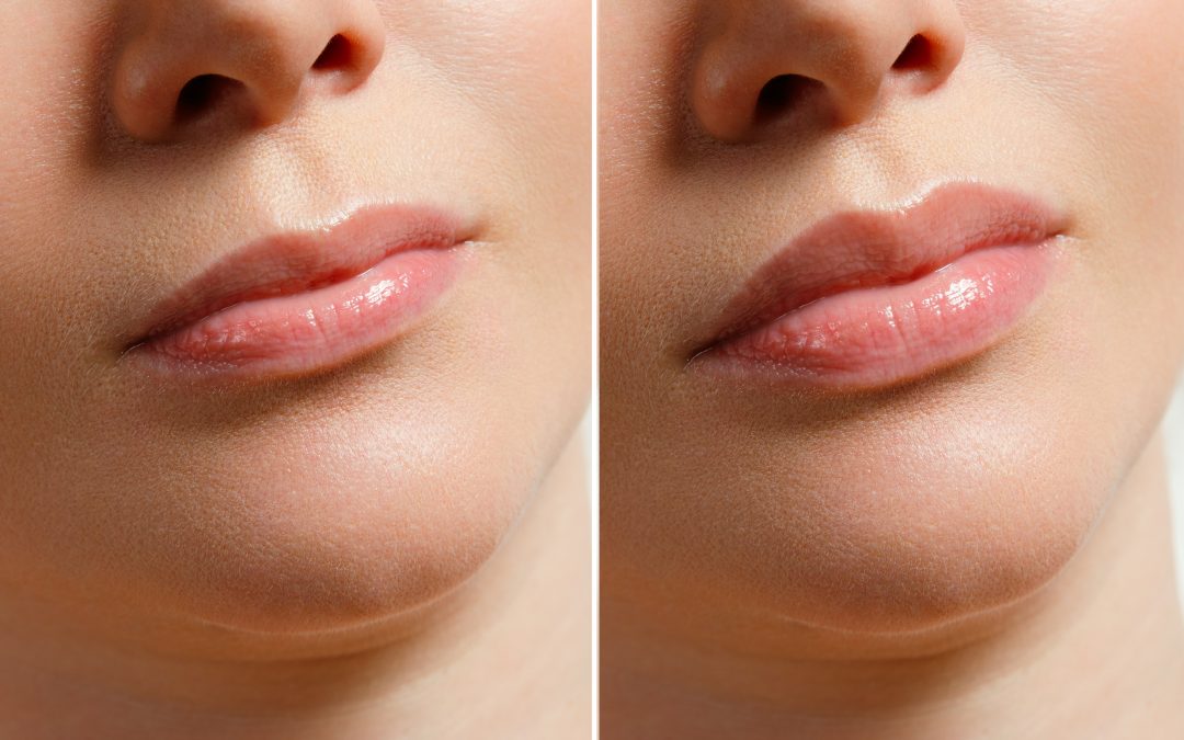 teosyal filler before and after